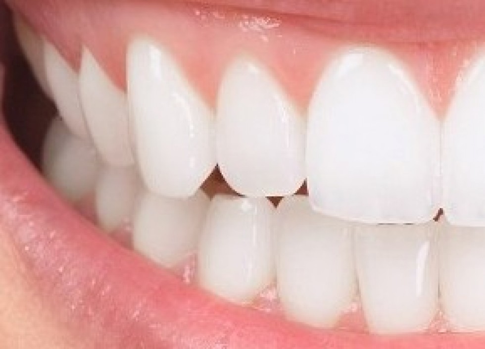 5 choses à connaitre sur les couronnes dentaires