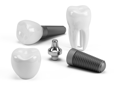 les implants dentaires moins chers