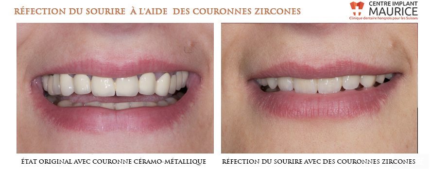 Couronne Zircone ou Céramique I Centre Implant Maurice